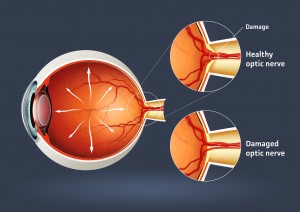glaucoma2