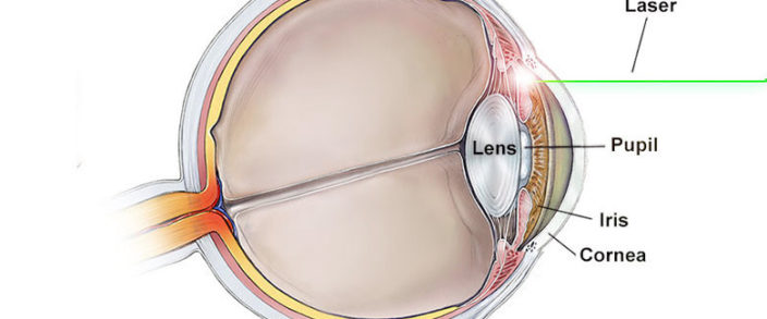 Peripheral Iridotomy (PI)