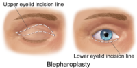 Blepharoplasty