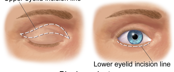 Blepharoplasty