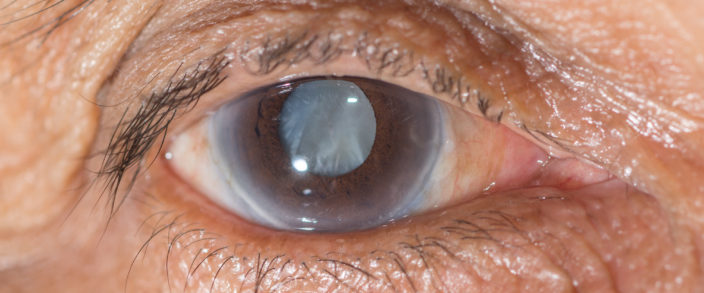 Cataract Extraction