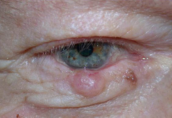 Eyelid Lesion Excision